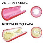 Comparação entre uma artéria normal e uma artéria bloqueada afectada pelo excesso de colesterol no sangue